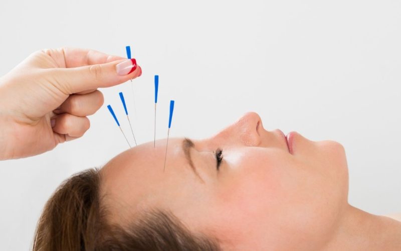 Acupuncture